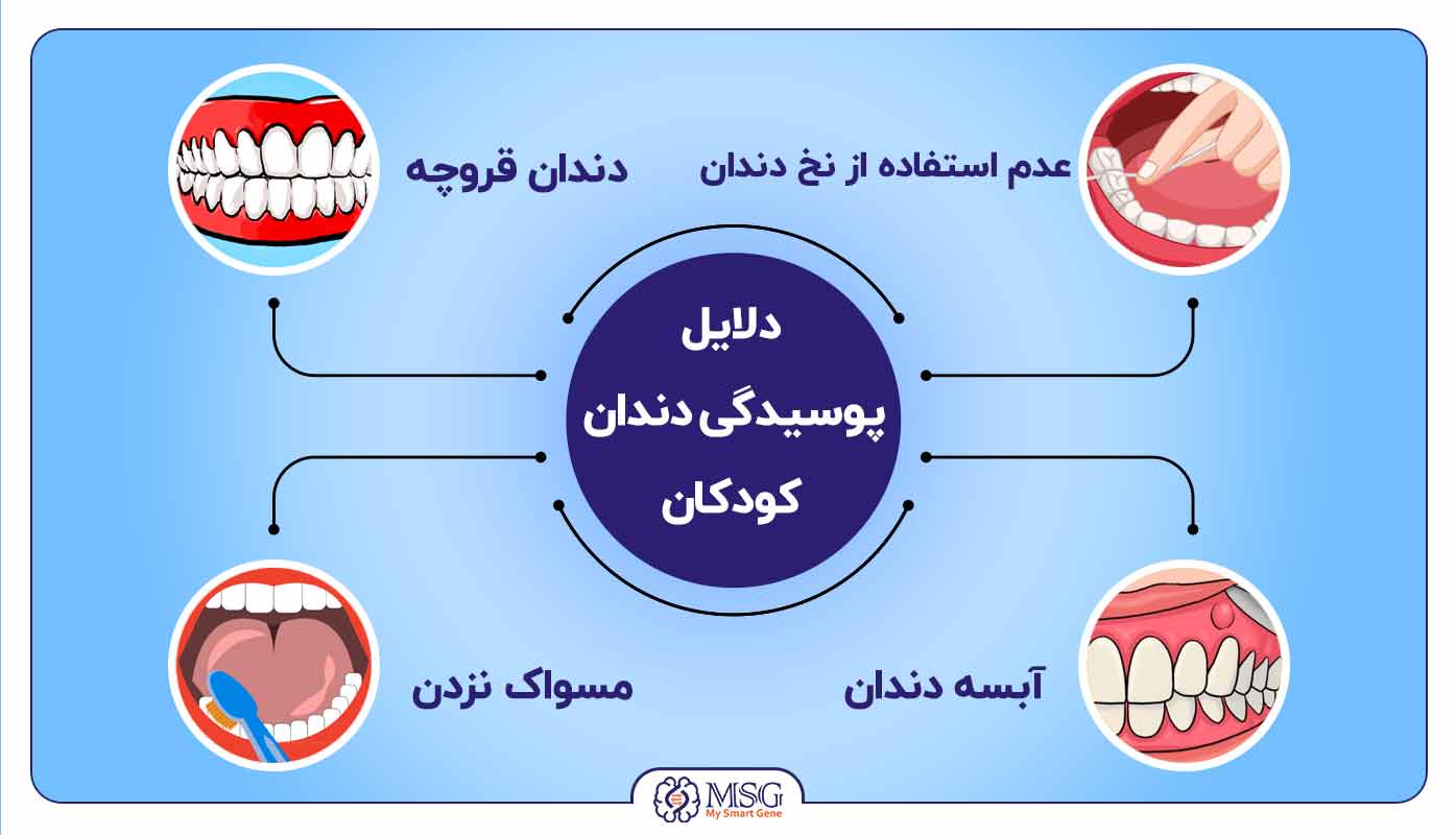 علت پوسیدگی دندان کودکان