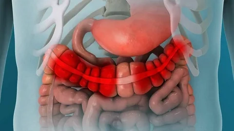 سندرم روده تحریک پذیر