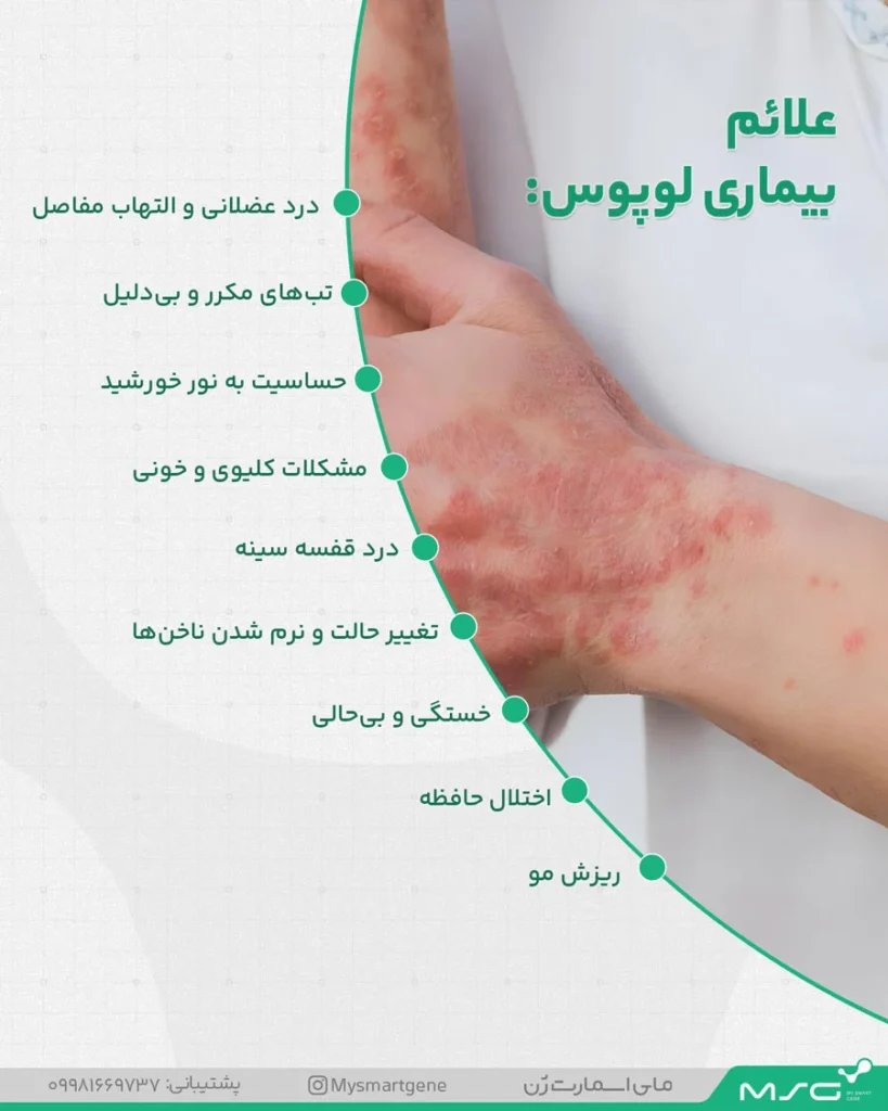 علائم بیماری لوپوس