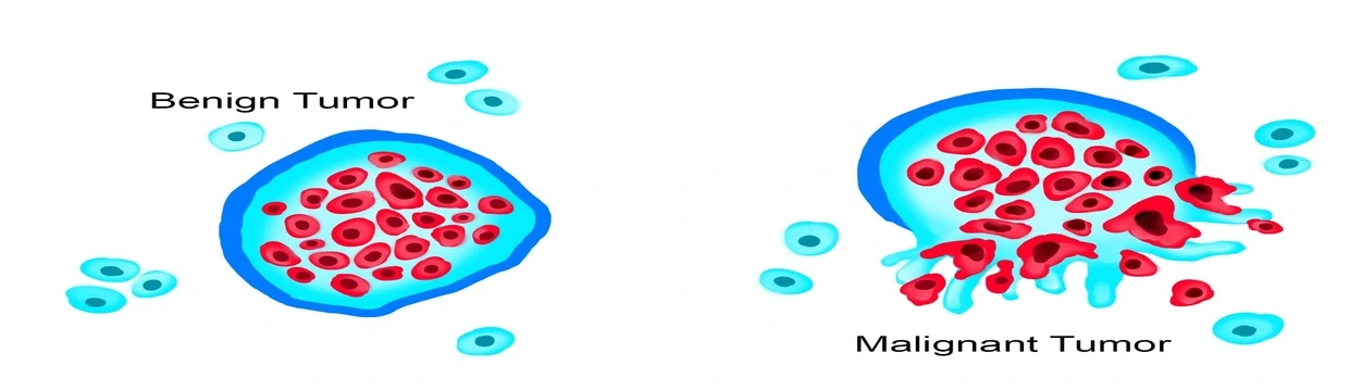 تفاوت تومور خوش خیم و بدخیم