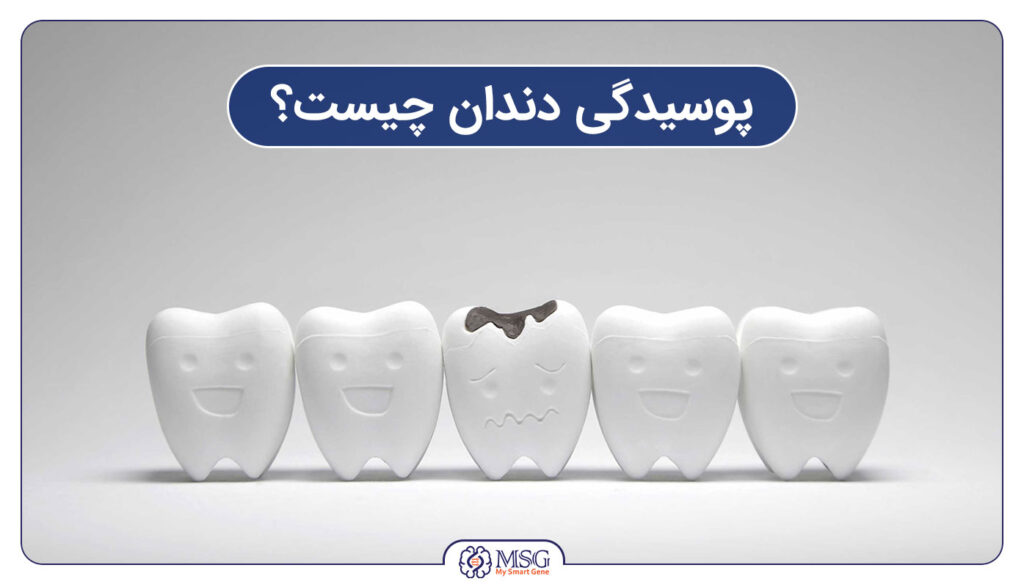 پوسیدگی دندان چیست؟