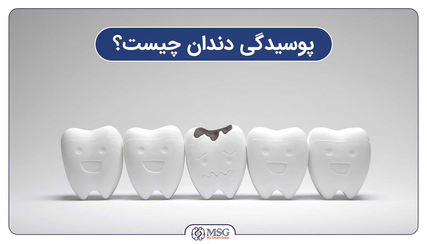 پوسیدگی دندان چیست؟