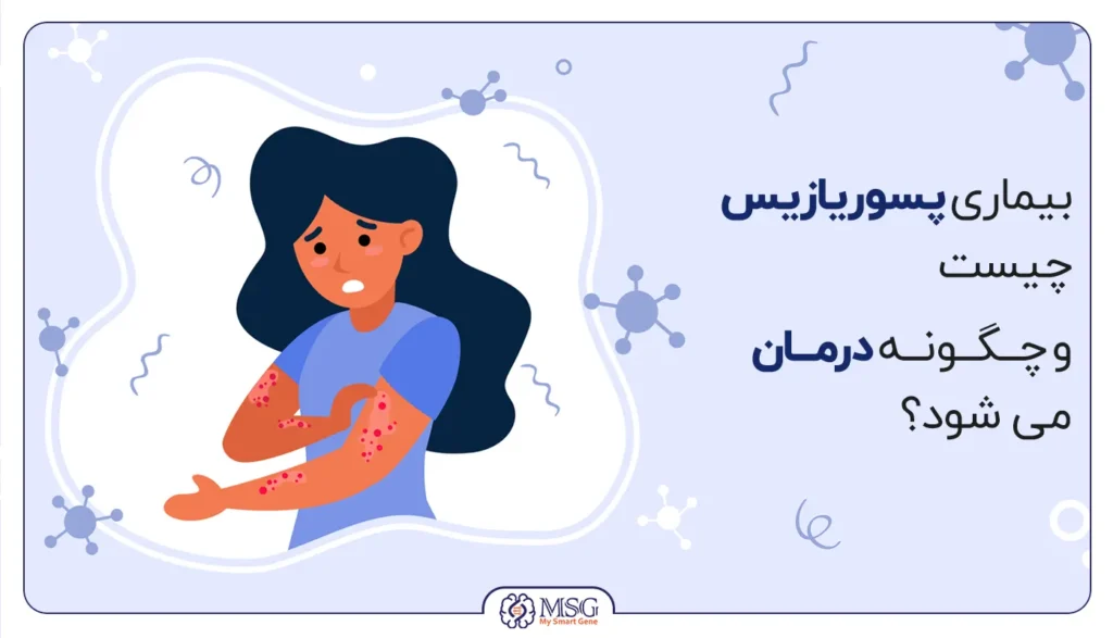 بیماری پسوریازیس چیست و چگونه درمان می شود
