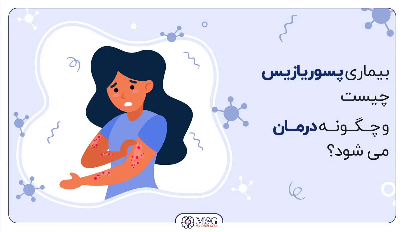 بیماری پسوریازیس چیست و چگونه درمان می شود