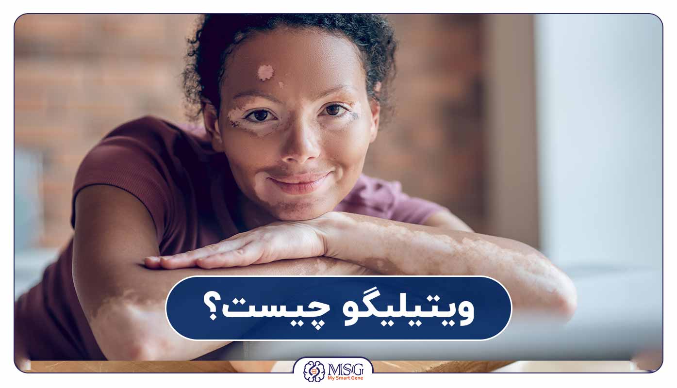 ویتیلیگو چیست؟
