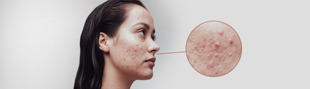 جوش ژنتیکی چیست؟