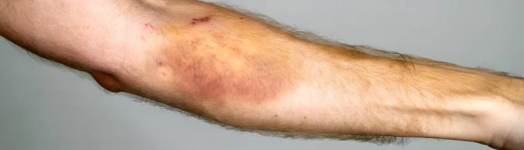 همه چیز درباره پلاکت خون پایین