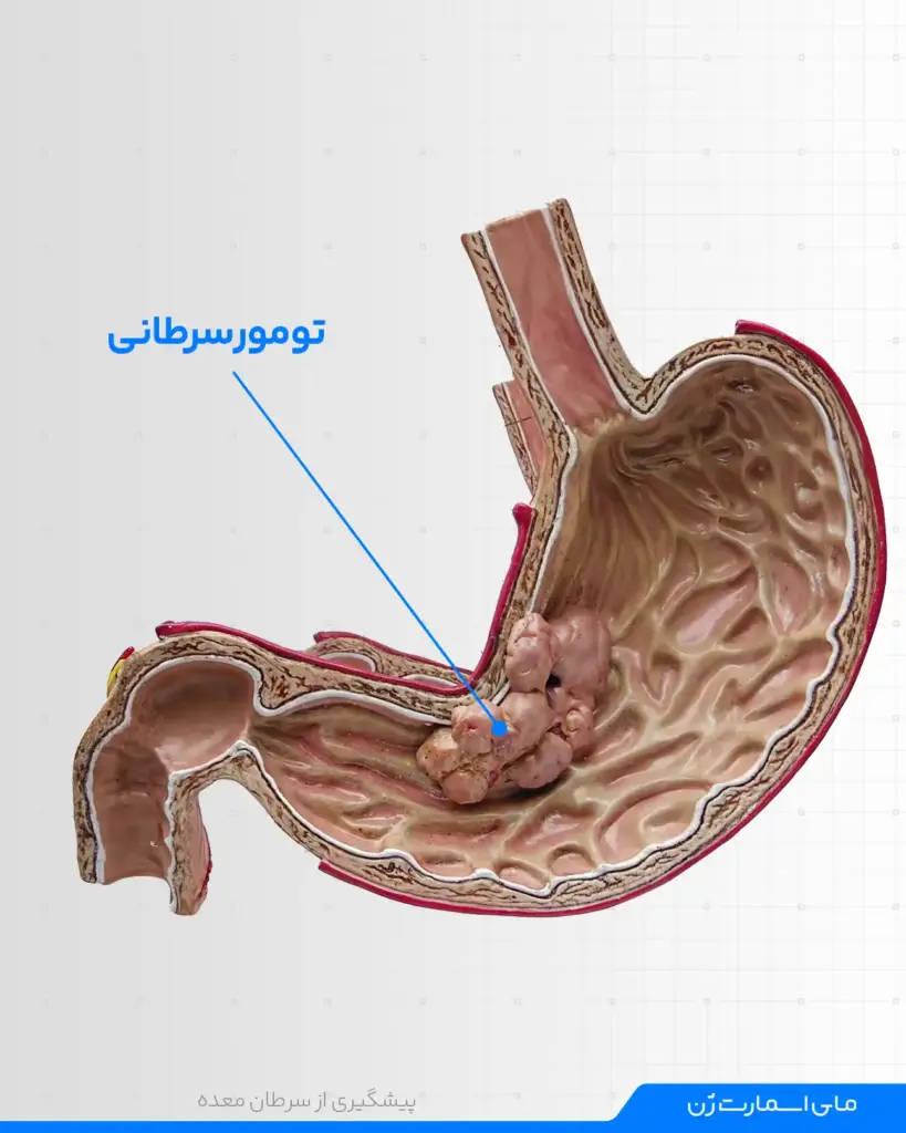  آیا سرطان معده کشنده است؟