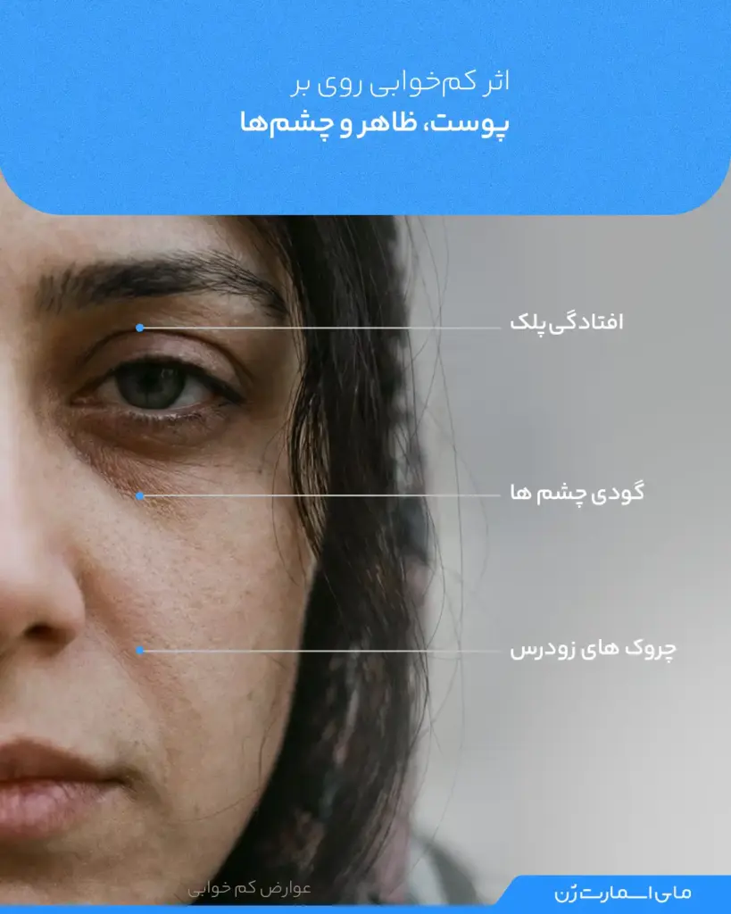 تصویر از نیم رخ راست یک خانم که عوارض کم خوابی روی پوست و چشم ها را نشان میدهد