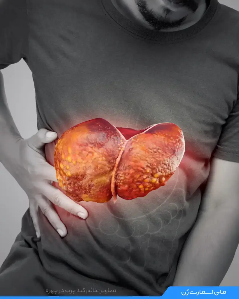 عضو کبد چرب