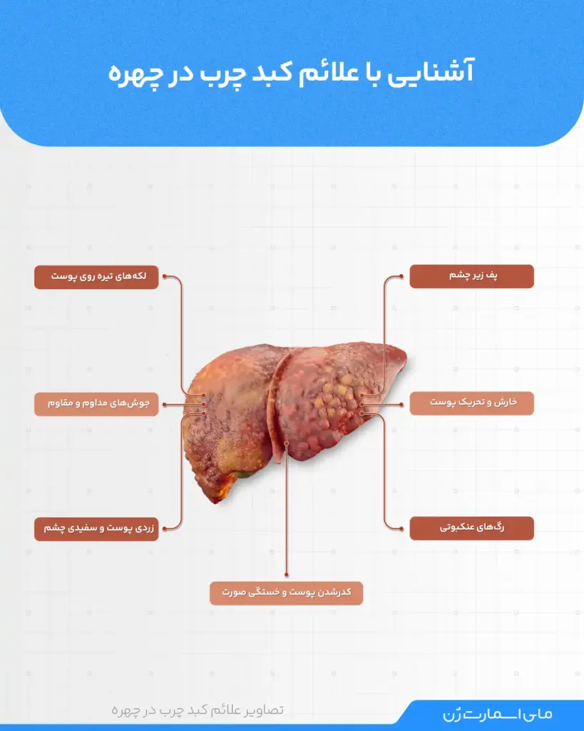 اینفوگرافیک علائم کبد چرب