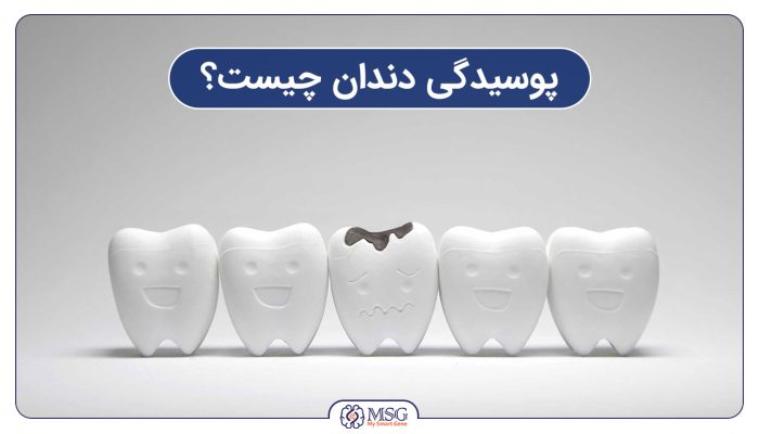 پوسیدگی دندان چیست؟
